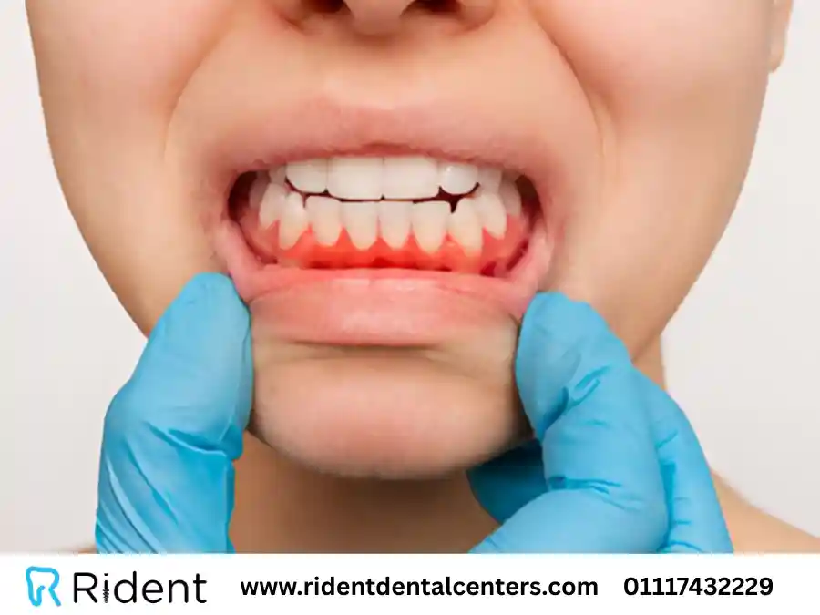 علاج التهاب اللثة بـ 3 طرق ونصائح هامة